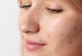 How Microneedling Can Improve the Appearance of Acne Scars