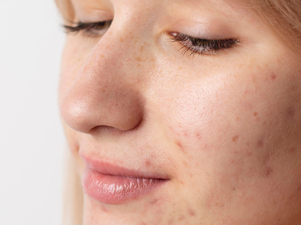 How Microneedling Can Improve the Appearance of Acne Scars