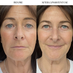 Before and after comparison of a woman's face with visible skin improvement.