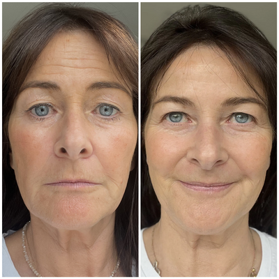 Before and after comparison of a woman's face with visible aging changes.